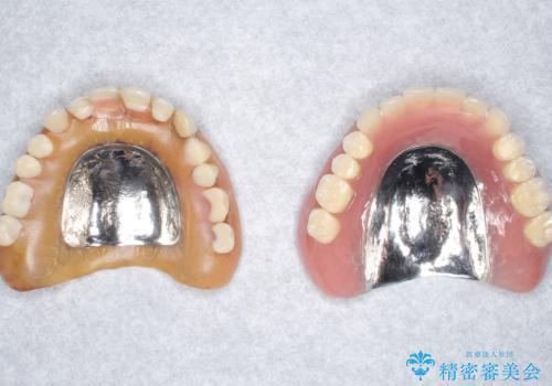 上の入れ歯がゆるくてはずれやすい　適合の良い金属床義歯　70代女性の治療中
