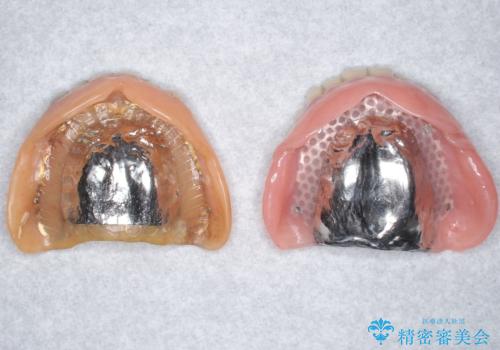 上の入れ歯がゆるくてはずれやすい 適合の良い金属床義歯 70代女性の治療中