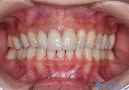歯並びの改善とインプラントでのかみ合わせの回復　インプラント・セラミック・矯正全顎治療の症例 治療後