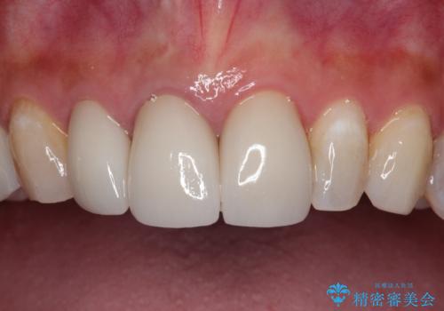 歯並びの改善とインプラントでのかみ合わせの回復 インプラント・セラミック・矯正全顎治療の治療後