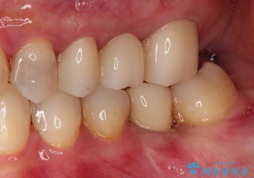 歯並びの改善とインプラントでのかみ合わせの回復 インプラント・セラミック・矯正全顎治療の治療後
