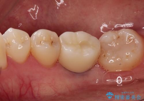 歯並びの改善とインプラントでのかみ合わせの回復 インプラント・セラミック・矯正全顎治療の治療後