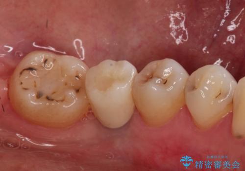 歯並びの改善とインプラントでのかみ合わせの回復 インプラント・セラミック・矯正全顎治療の治療後