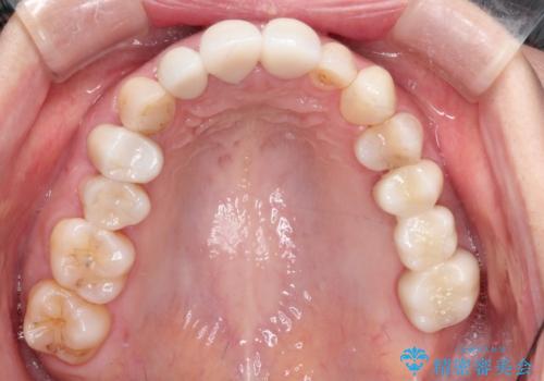歯並びの改善とインプラントでのかみ合わせの回復 インプラント・セラミック・矯正全顎治療の治療後