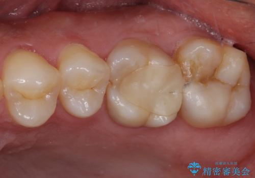 耳鼻科で指摘されたむし歯 根管治療とセラミッククラウンの症例 治療前