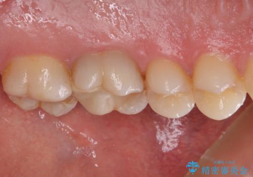 耳鼻科で指摘されたむし歯 根管治療とセラミッククラウンの治療前