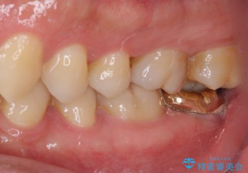 耳鼻科で指摘されたむし歯 根管治療とセラミッククラウンの治療前