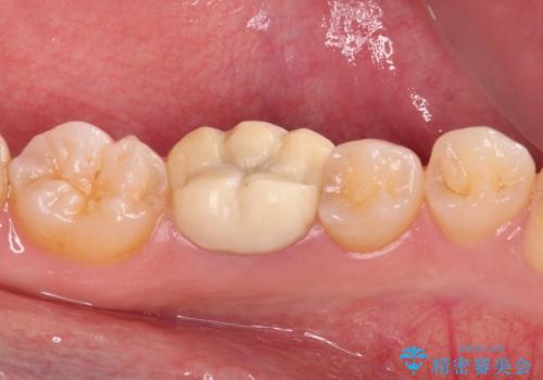 奥歯の被せものが汚れやすい 仮歯のままの歯をセラミッククラウンにの治療前