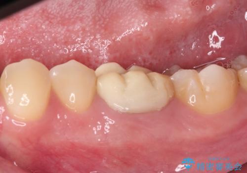 奥歯の被せものが汚れやすい 仮歯のままの歯をセラミッククラウンにの治療前