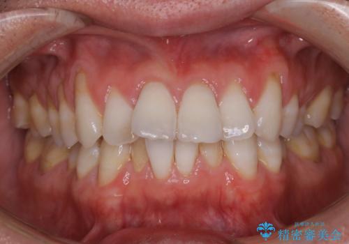 歯のクリーニング(PMTC)の治療前