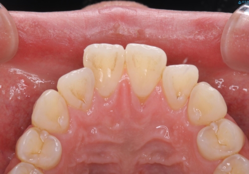 歯のクリーニング(PMTC)の治療前