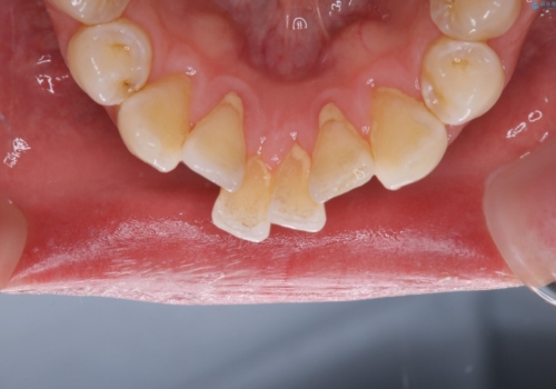 歯のクリーニング(PMTC)の治療前