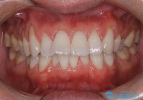 歯のクリーニング(PMTC)の治療後