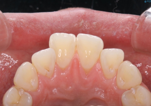 歯のクリーニング(PMTC)の治療後