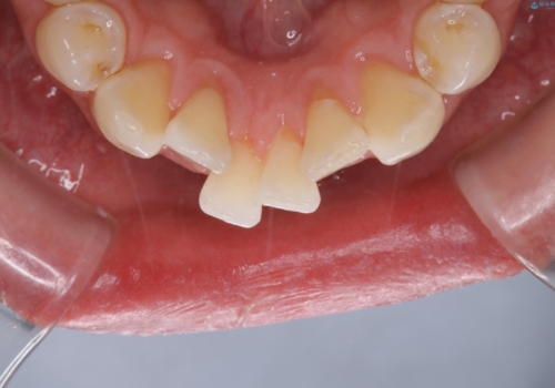歯のクリーニング(PMTC)の治療後