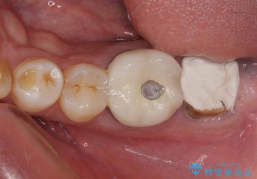 抜歯が必要な奥歯　ストローマン・インプラント補綴治療の症例 治療前