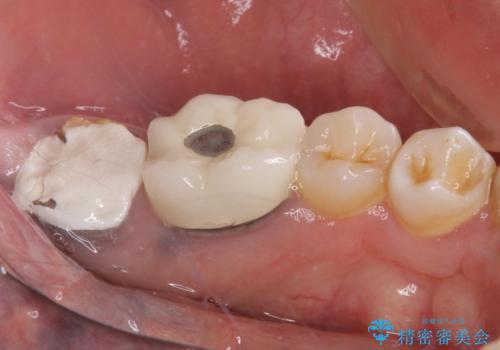抜歯が必要な奥歯　ストローマン・インプラント補綴治療の治療前