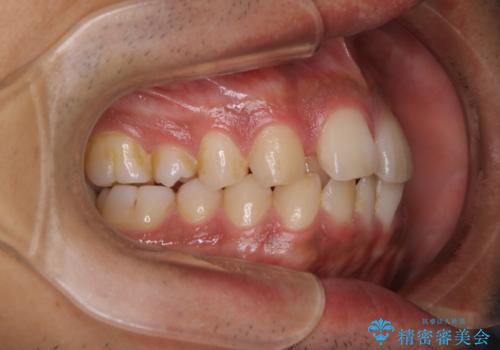 矯正をスタートする前にクリーニング(PMTC60分)の治療前