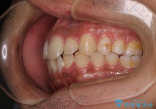 矯正をスタートする前にクリーニング(PMTC60分)の治療前