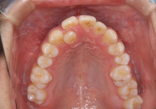 矯正をスタートする前にクリーニング(PMTC60分)の治療前
