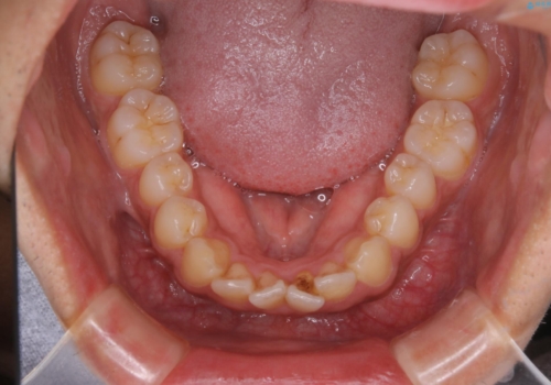 矯正をスタートする前にクリーニング(PMTC60分)の治療前