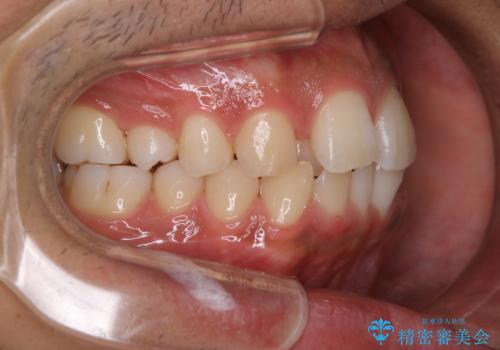 矯正をスタートする前にクリーニング(PMTC60分)の治療後