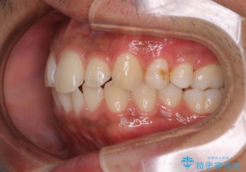 矯正をスタートする前にクリーニング(PMTC60分)の治療後