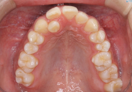 矯正をスタートする前にクリーニング(PMTC60分)の治療後