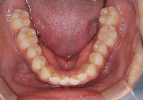 矯正をスタートする前にクリーニング(PMTC60分)の治療後