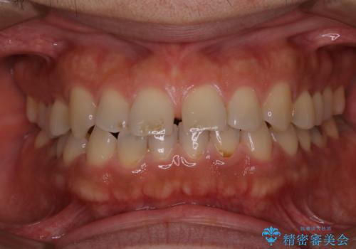 歯の着色落としの治療前