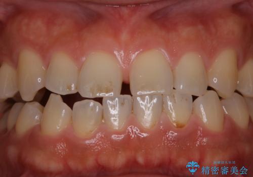 歯の着色落としの治療前
