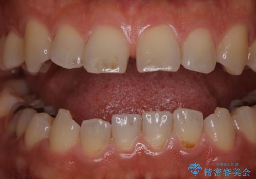 歯の着色落としの治療前