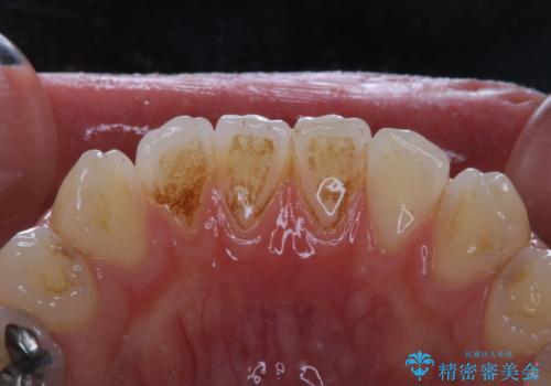 歯の着色落としの治療前