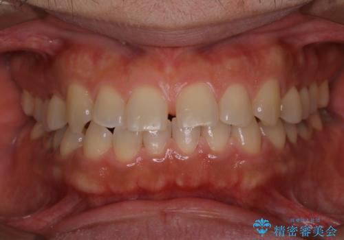 歯の着色落としの治療後