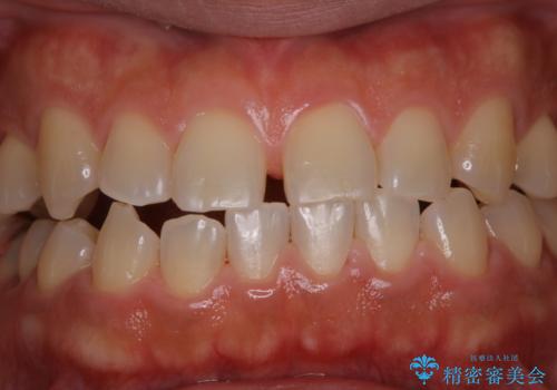 歯の着色落としの治療後