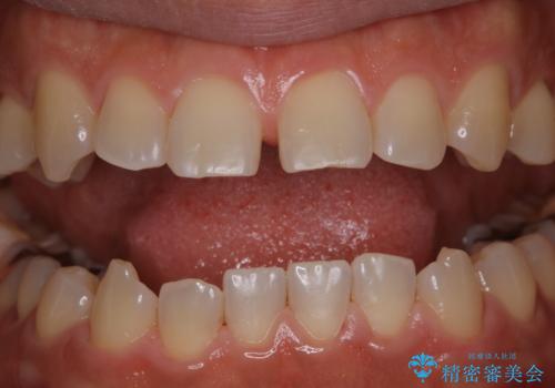歯の着色落としの治療後