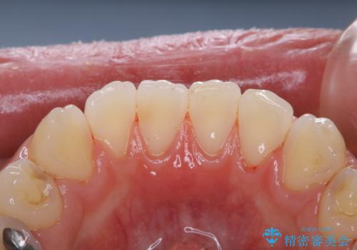 歯の着色落としの治療後