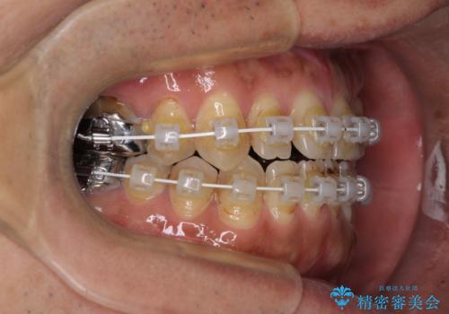 前歯の反対咬合をワイヤー矯正で改善して噛みやすくの治療中