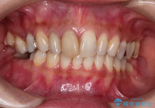 歯並びの改善と<span class=