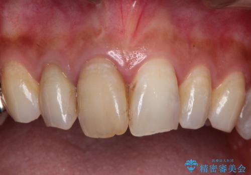 歯並びの改善とインプラントでのかみ合わせの回復 インプラント・セラミック・矯正全顎治療の治療前
