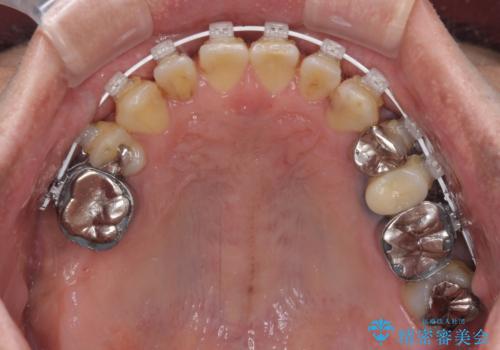 前歯の反対咬合をワイヤー矯正で改善して噛みやすくの治療中