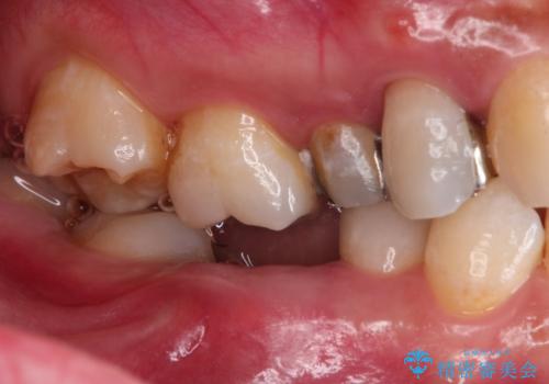 歯並びの改善とインプラントでのかみ合わせの回復 インプラント・セラミック・矯正全顎治療の治療前