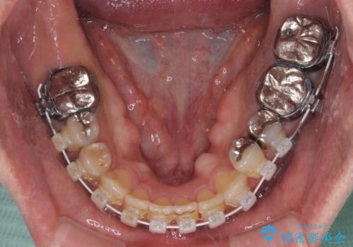 前歯の反対咬合をワイヤー矯正で改善して噛みやすくの治療中