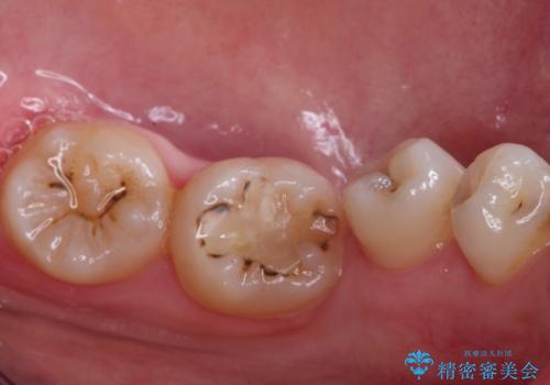 歯並びの改善とインプラントでのかみ合わせの回復 インプラント・セラミック・矯正全顎治療の治療前