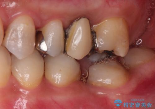 歯並びの改善とインプラントでのかみ合わせの回復 インプラント・セラミック・矯正全顎治療の治療前