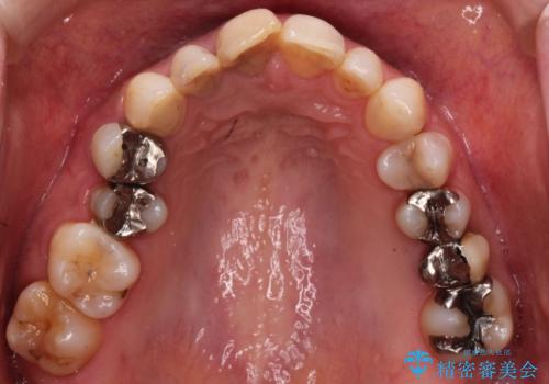 歯並びの改善とインプラントでのかみ合わせの回復 インプラント・セラミック・矯正全顎治療の治療前