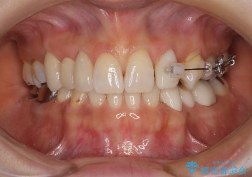 欠損の多い歯列 部分矯正とセラミックブリッジで自然な見た目にの治療中