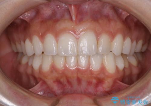 部分矯正とインビザラインを組み合わせて短期間での矯正治療の治療後