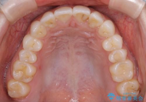 部分矯正とインビザラインを組み合わせて短期間での矯正治療の治療後