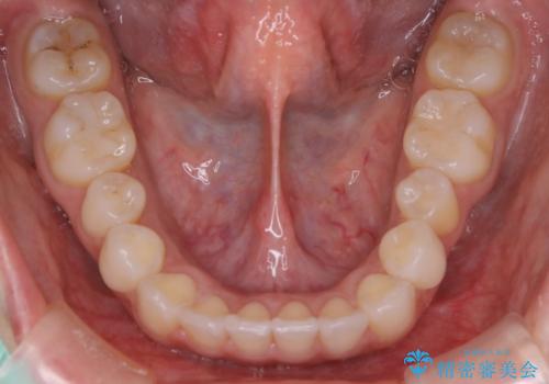 部分矯正とインビザラインを組み合わせて短期間での矯正治療の治療後